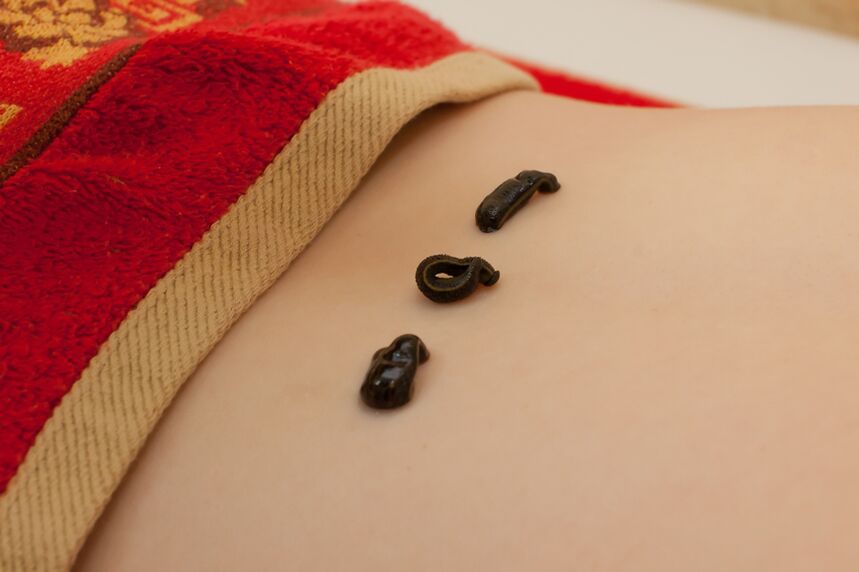 Sanguixas na parte baixa das costas con osteocondrose